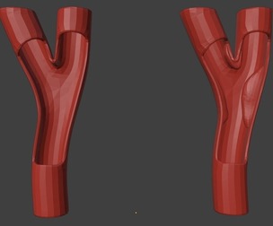 3D Model of Peripheral Artery Disease