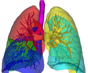 3D Model of Lungs, Vessels and Airways - generated from real patient