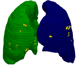 3D Model of Lungs Infected with Covid19