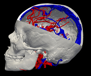 3D Model of Brain Arteriovenous Malformation