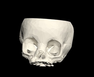 3D Model of Middle Cerebral Artery (MCA) Aneurysm