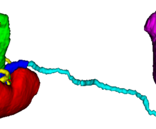 3D Model of Urinary System - generated from real patient