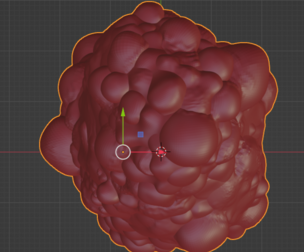 3D Model of Polycystic Kidney