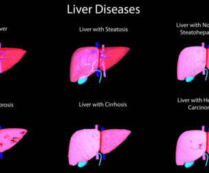 3D Models of Liver Disease - bundle - 6 pack