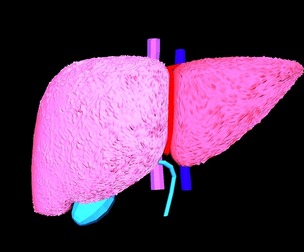 3D Model of Liver with Non-alchocolic steatohepatitis (NASH)
