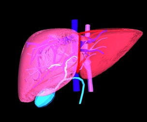 3D Model of Liver with Steatosis