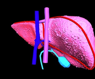 3D Model of Liver with Cirrhosis