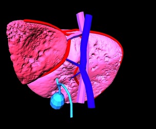 3D Model of Liver with Fibrosis