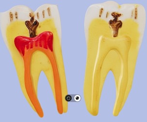 3D Model of Diseased Teeth