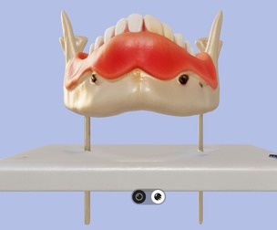 3D Model of Dental Disease (Lower Jaw)
