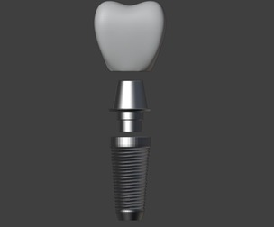 3D Model of Tooth Implant - Dental Model