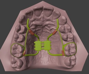 3D Model of Teeth and Rapid Palatal Expander