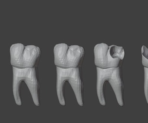 3D Model of Tooth Decay Progression - Dental Model