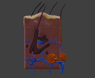 3D Model of Psoriasis Skin - Cross Section