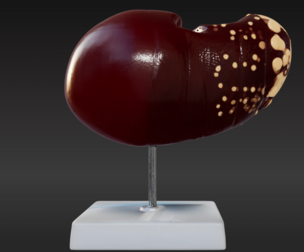 3D Model of Human Liver with the Progression of Liver Disease