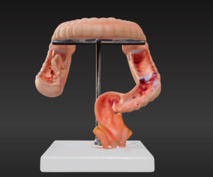 3D Model fo Intestinal Diseases