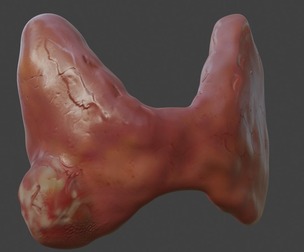 3D Model of Thyroid Gland with Cancer