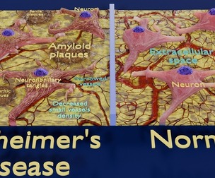 Alzheimer disease microscopy changes brain