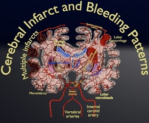 Stroke brain infarct hemorrhage types