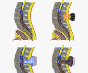 Spina bifida Neural Tube Defect