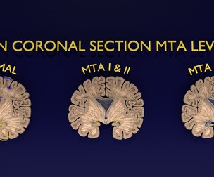 Hippocampus atrophy levels MTA 1-4