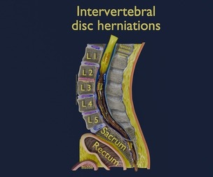 Intervertebral herniation slipped ruptured disc