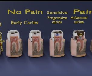 Caries Teeth severity schematic cut sectional