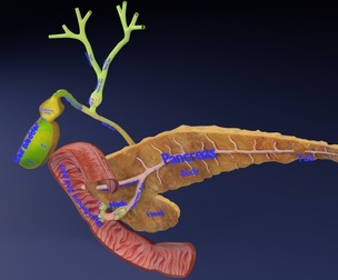 Biliary tract stone obstructions gallstone