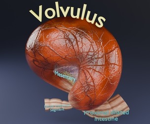 Volvulus intestine obstruction