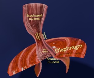 Gastro oesophageal reflux disease
