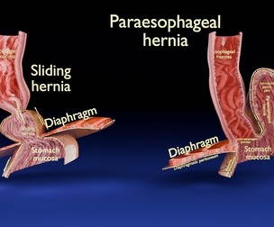 Hiatal hernia stomach sliding paraesophageal