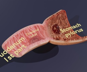 Peptic Ulcer Stomach duodenum