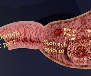 Gastric Ulcer Benign versus Malignant