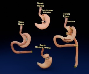 Bariatric Surgery Types