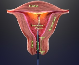 Endometrial Polyp Electrocautery