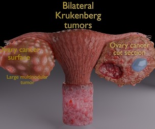 Krukenberg ovarian cancer tumor