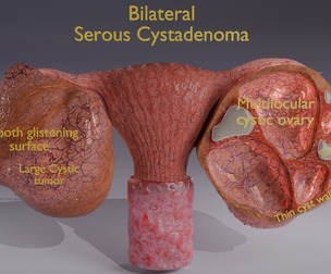 Ovary tumor benign non-cancerous serous cystadenoma