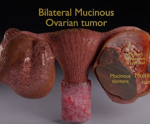 ovary mucinous cystic tumor