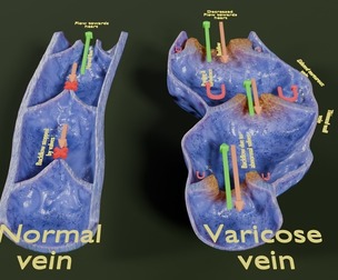 Varicose vein valve