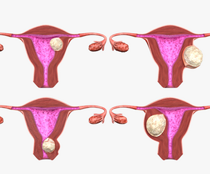 Uterus normal versus  fibroid types 3d set