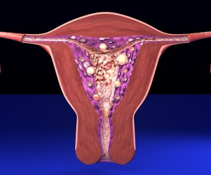 Uterus endometrial lesions model set - hyperplasia polyp cyst cancer model set