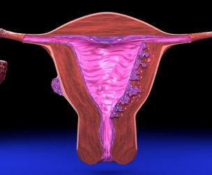 Uterus adenomyosis versus endometriosis 3d model