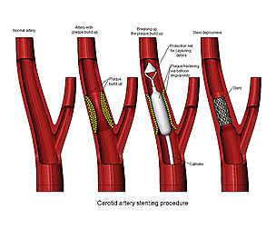 Carotid artery stenting procedure 3D print model